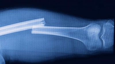 Glass and plastic implants to repair broken bones